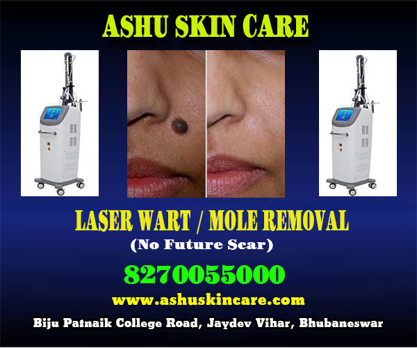 best mole removal clinic in bhubaneswar close to sum hospital